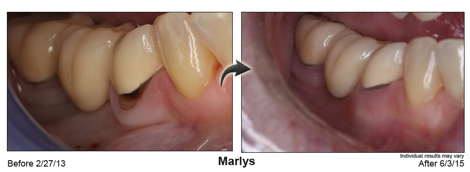 fix receding gums Lafayette